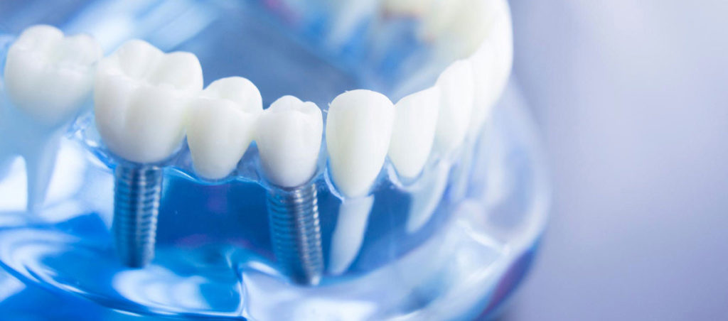 Clínica Dental Doctores Pampols y Brotons - Dentista de Confianza en Majadahonda - Implantes Dentales