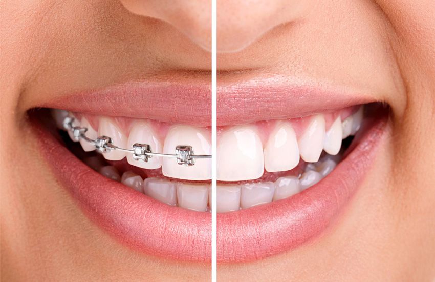 Blanqueamiento Dental Y Ortodoncia Para Devolver Sonrisa - Clinica Peydro