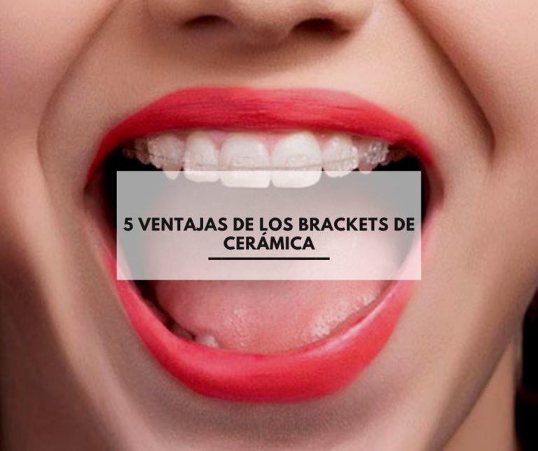 5 ventajas de los brackets de cerámica Clínica Doctores Pampols y Brotons
